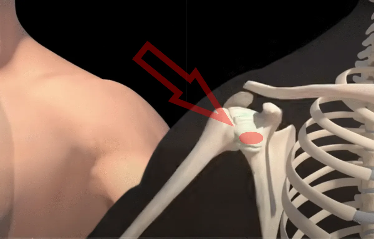 Anatomical diagram showing the structure of a healthy shoulder joint and capsule
